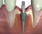 Ugradnja implantata - 3
